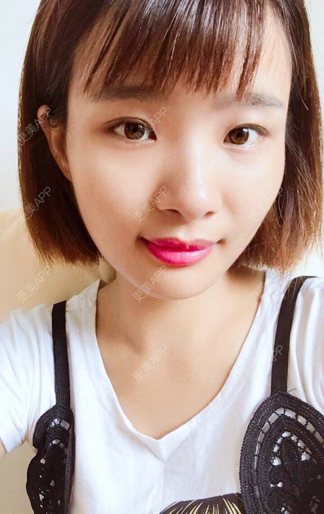 更美 - 照相机、的经验 | 注射美容 | 视频日记 | 重庆 | 自体脂肪丰全面部 | 吸脂手术
