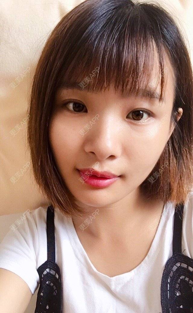 更美 - 照相机、的经验 | 注射美容 | 视频日记 | 重庆 | 自体脂肪丰全面部 | 吸脂手术