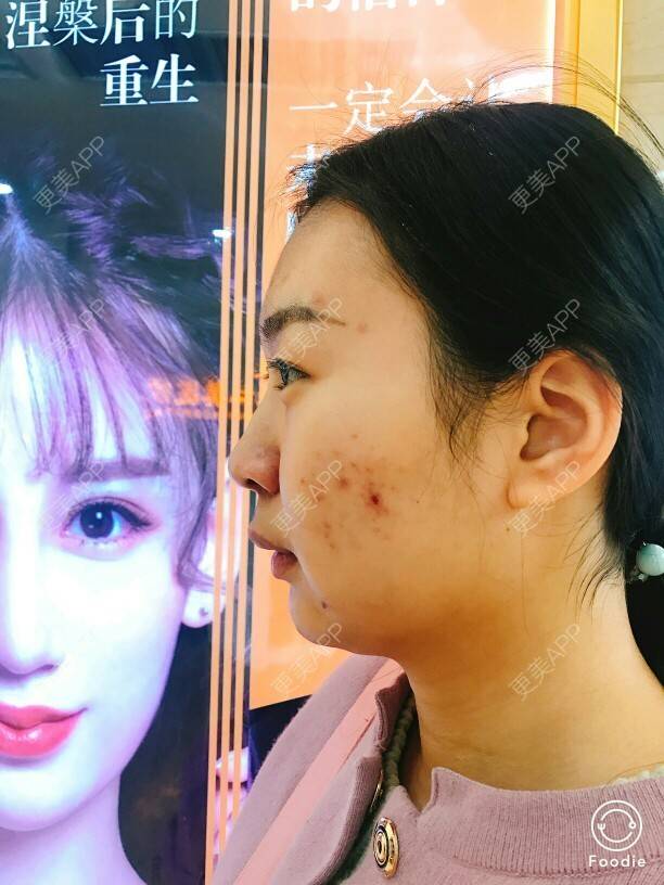 更美 - ⭐涵涵爱星星⭐的除皱瘦脸经验 | 注射瘦脸· | 哈尔滨 | 除皱瘦脸 | 怎样瘦脸