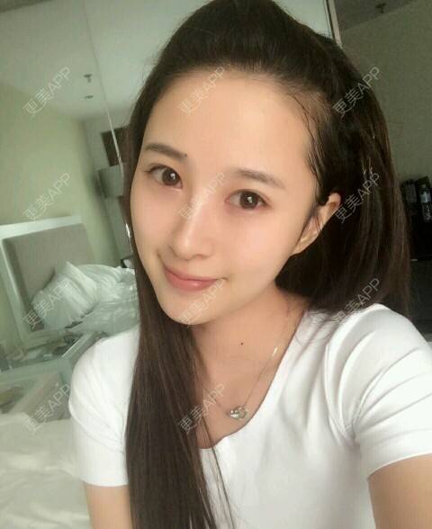 双眼皮,双眼皮前后对比照_七夏17双眼皮前后对比照_术后72天__更美