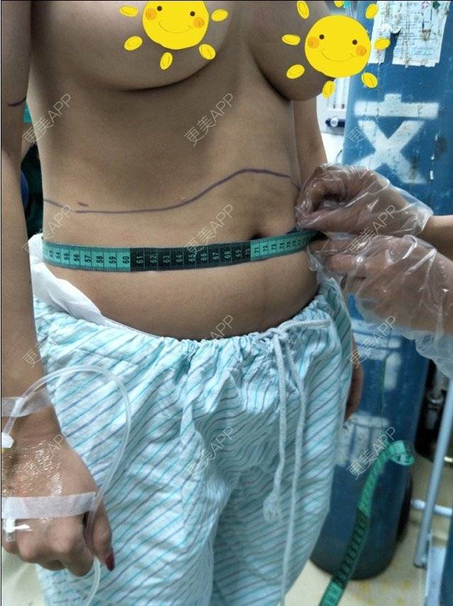 更美 - 宛若霓裳的腰腹吸脂经验 | 侧腰吸脂 | 腰腹吸脂 | 树洞：八卦和我讲！ | 深圳