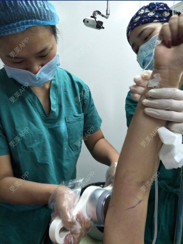 更美 - 宛若霓裳的腰腹吸脂经验 | 侧腰吸脂 | 腰腹吸脂 | 树洞：八卦和我讲！ | 深圳