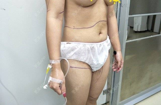 更美 - 宛若霓裳的腰腹吸脂经验 | 侧腰吸脂 | 腰腹吸脂 | 树洞：八卦和我讲！ | 深圳