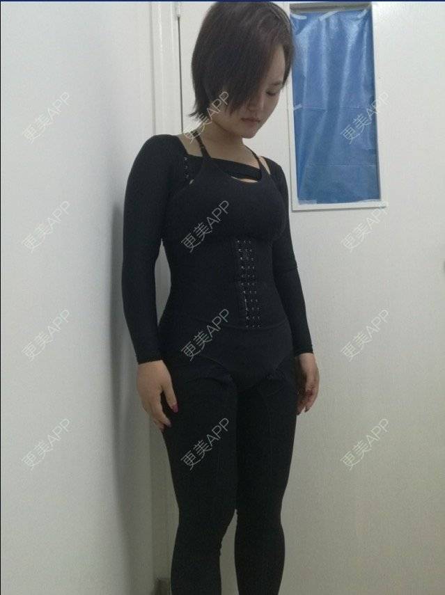 更美 - 宛若霓裳的腰腹吸脂经验 | 侧腰吸脂 | 腰腹吸脂 | 树洞：八卦和我讲！ | 深圳