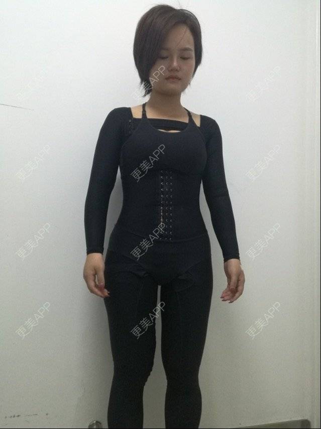 更美 - 宛若霓裳的腰腹吸脂经验 | 侧腰吸脂 | 腰腹吸脂 | 树洞：八卦和我讲！ | 深圳