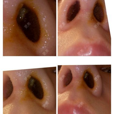 鼻综合20天鼻孔假体外漏怎么办