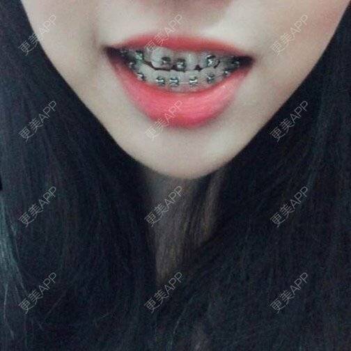 更美 - 赶回家郭德纲的经验 | 牙齿正畸 | 西安 | 西安同城