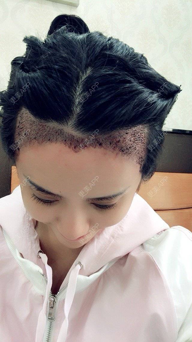 1344的植发际线日记