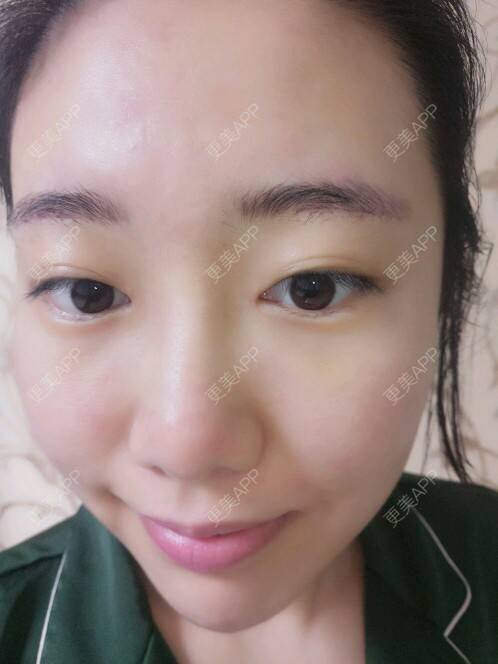 更美 - Cold婷的切眉经验 | 内开眼角 | 眼睛大小 | 切眉 | 长沙