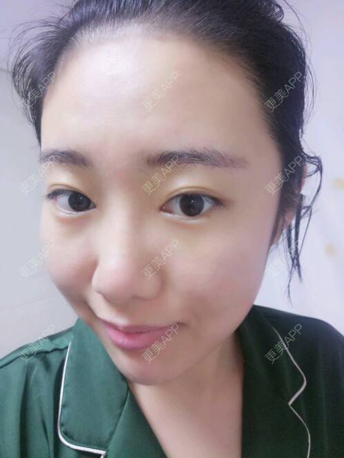 更美 - Cold婷的切眉经验 | 内开眼角 | 眼睛大小 | 切眉 | 长沙