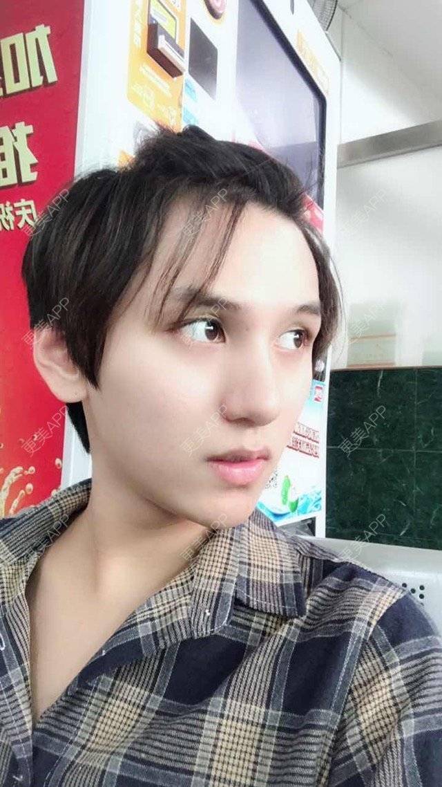 更美 - 更美用户oPEWZhmBlZ的除皱瘦脸经验 | 注射瘦脸针 | 瘦脸针术后 | 除皱瘦脸 | 潮州