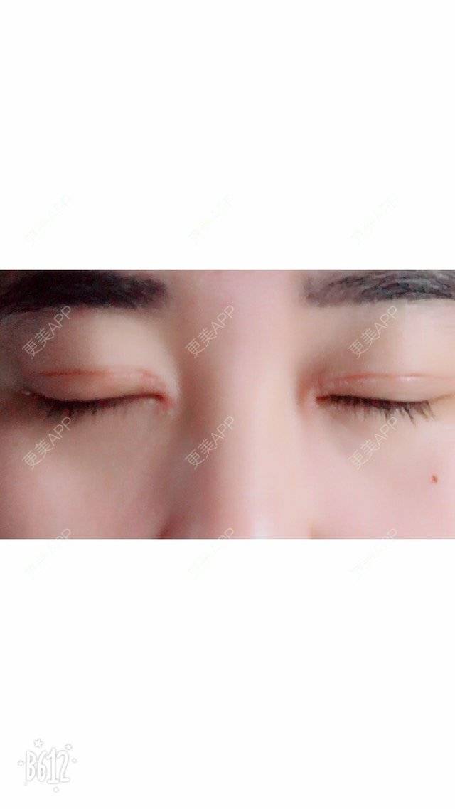 更美 - 超甜超甜的双眼皮经验 | 开内眼角 | 北京 | 双眼皮