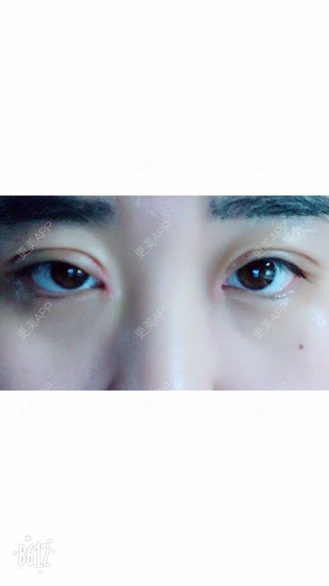 更美 - 超甜超甜的双眼皮经验 | 开内眼角 | 北京 | 双眼皮