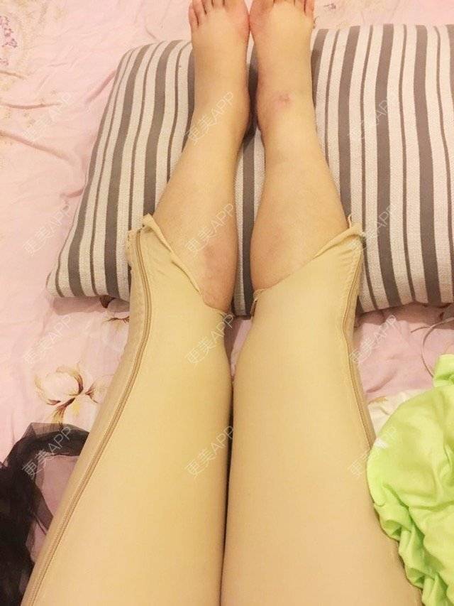 更美 - 葡萄榴莲的经验 | 侧腰吸脂 | 吸脂瘦大腿瘦gu | 深圳