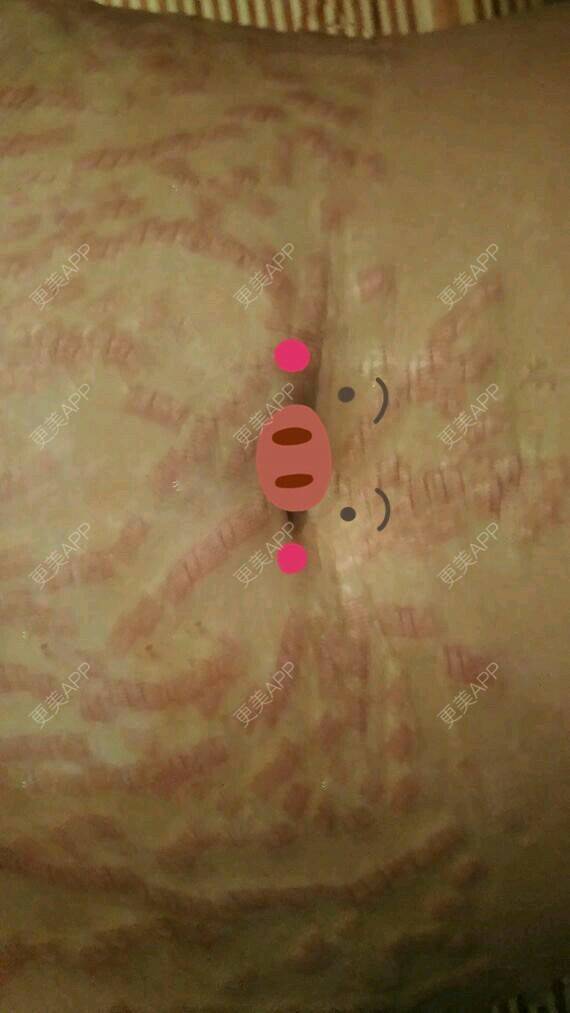 激光淡化妊娠纹整形_更美用户v65mqufbhm_更美