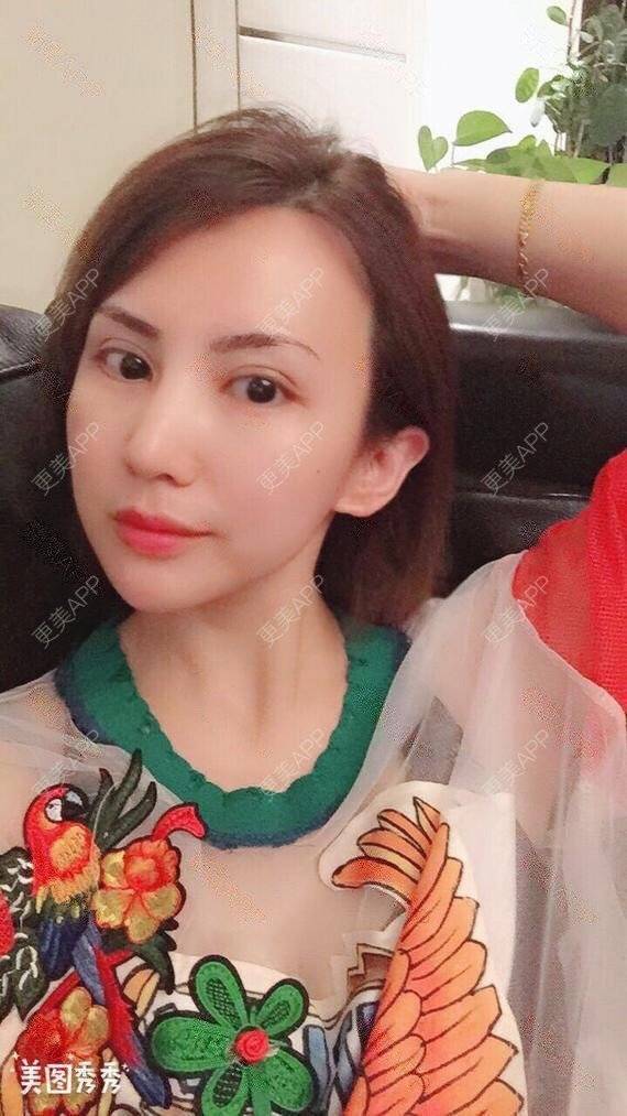 更美 - 龙鹏辉 医生的双眼皮经验 | 广州 | 双眼皮