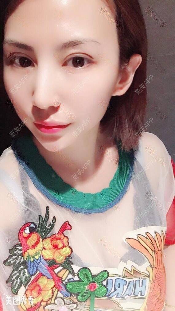 更美 - 龙鹏辉 医生的双眼皮经验 | 广州 | 双眼皮