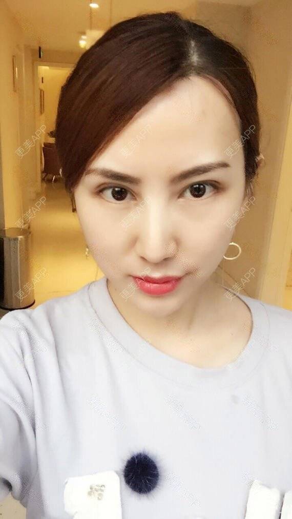 更美 - 龙鹏辉 医生的双眼皮经验 | 广州 | 双眼皮