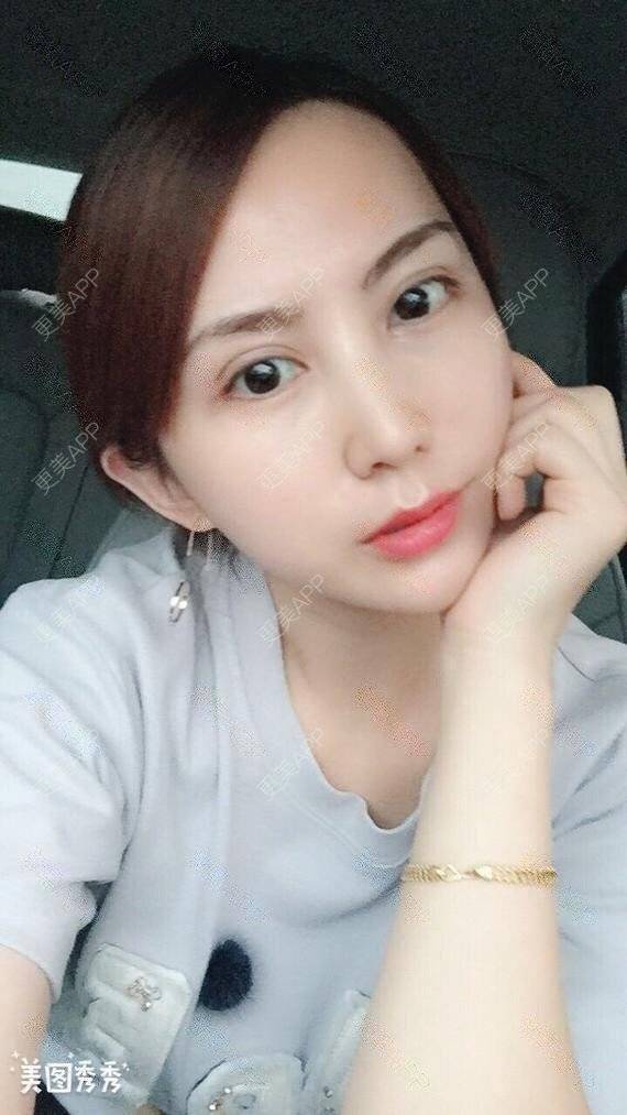 更美 - 龙鹏辉 医生的双眼皮经验 | 广州 | 双眼皮