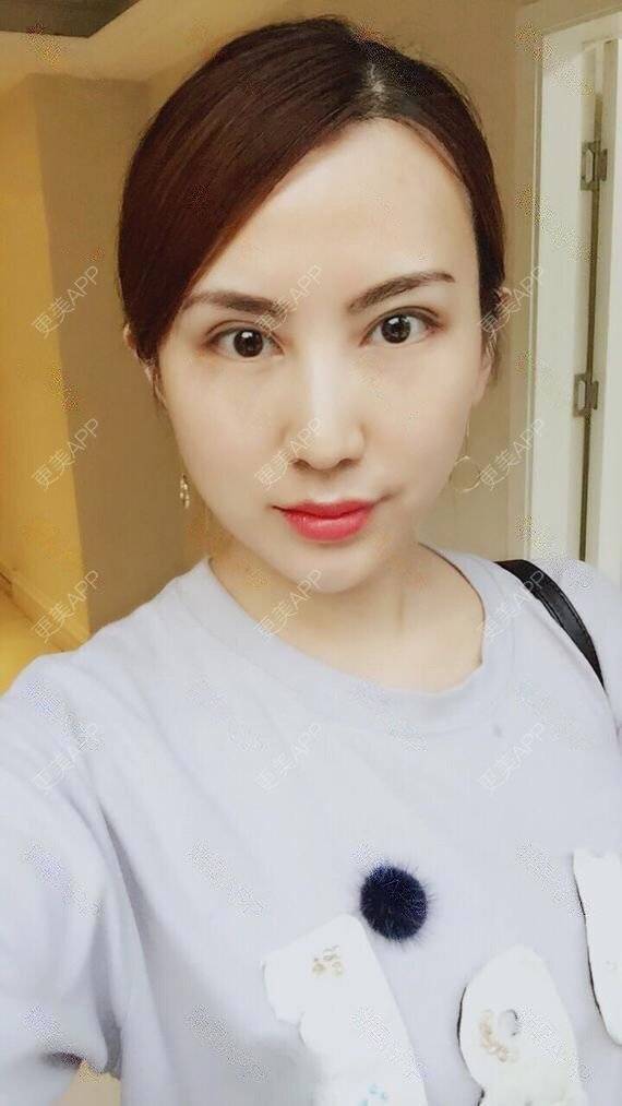 更美 - 龙鹏辉 医生的双眼皮经验 | 广州 | 双眼皮