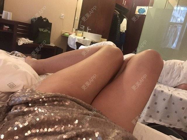 更美 - 朱渺 医生的吸脂瘦大腿经验 | 长沙 | 吸脂瘦大腿