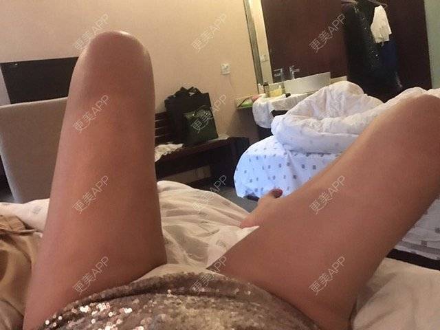 更美 - 朱渺 医生的吸脂瘦大腿经验 | 长沙 | 吸脂瘦大腿