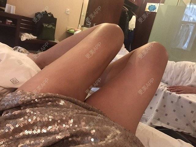 更美 - 朱渺 医生的吸脂瘦大腿经验 | 长沙 | 吸脂瘦大腿