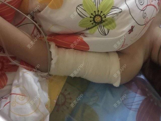 更美 - 更美用户uhjgJzL3xQ的吸脂瘦大腿经验 | 手臂吸脂 | 自体脂肪丰全面部 | 吸脂瘦大腿 | 广州