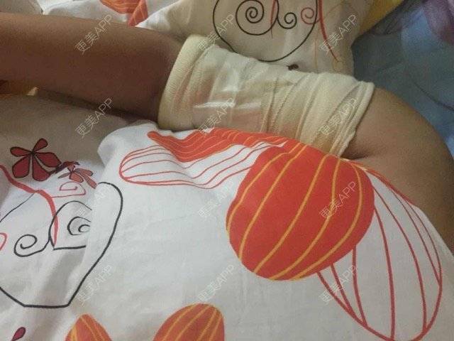 更美 - 更美用户uhjgJzL3xQ的吸脂瘦大腿经验 | 手臂吸脂 | 自体脂肪丰全面部 | 吸脂瘦大腿 | 广州