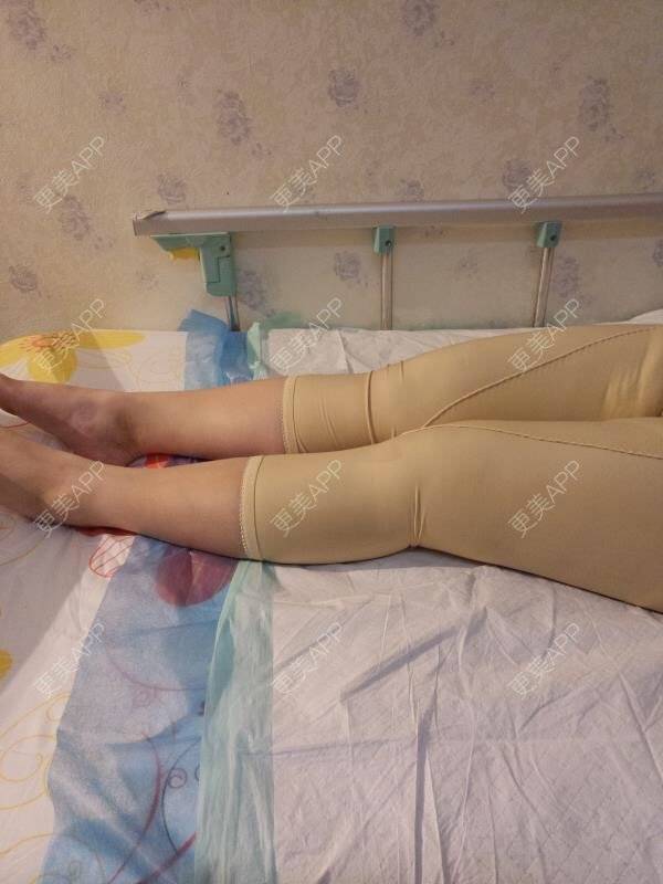 更美 - 更美用户uhjgJzL3xQ的吸脂瘦大腿经验 | 手臂吸脂 | 自体脂肪丰全面部 | 吸脂瘦大腿 | 广州