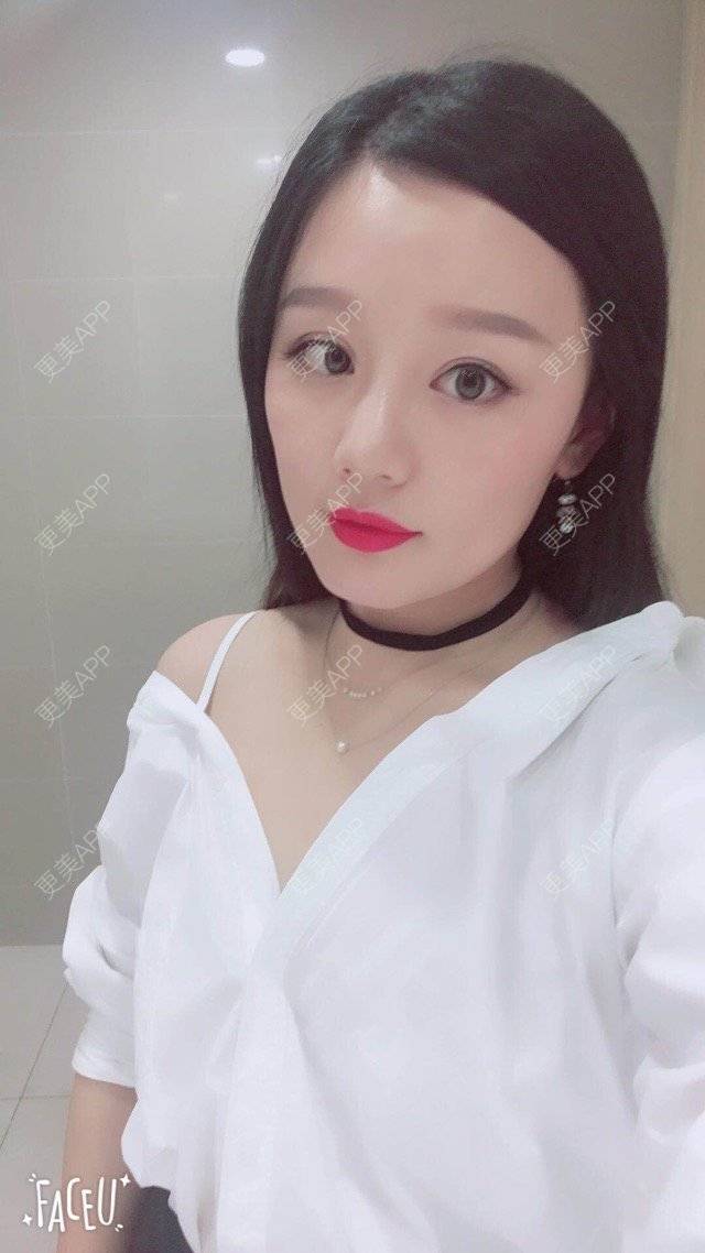 更美 - 武汉美莱医疗美容医院的全切双眼皮经验 | 全切双眼皮 | 武汉