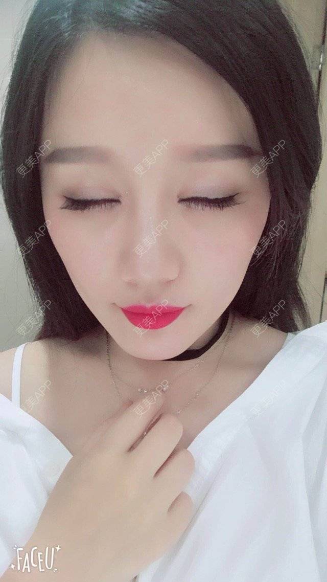 更美 - 武汉美莱医疗美容医院的全切双眼皮经验 | 全切双眼皮 | 武汉