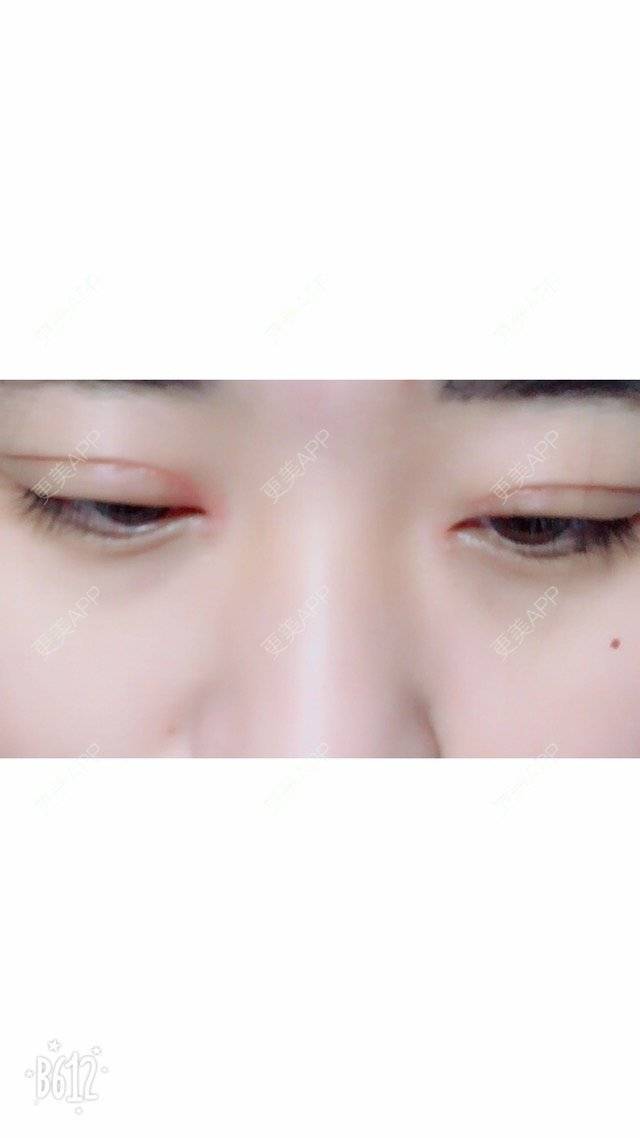 更美 - 超甜超甜的双眼皮经验 | 北京 | 视频日记 | 双眼皮