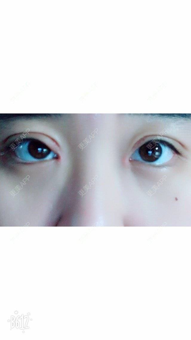 更美 - 超甜超甜的双眼皮经验 | 北京 | 视频日记 | 双眼皮