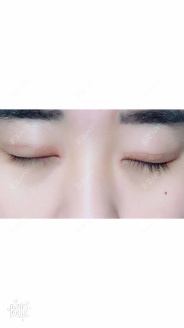 更美 - 超甜超甜的双眼皮经验 | 北京 | 视频日记 | 双眼皮