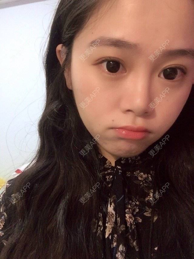 更美 - 摩西呀的水光项目经验 | 成都 | 去痘印 | 水光项目 | 光子嫩肤