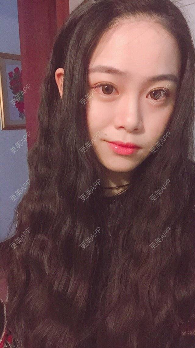 更美 - 摩西呀的水光项目经验 | 成都 | 去痘印 | 水光项目 | 光子嫩肤