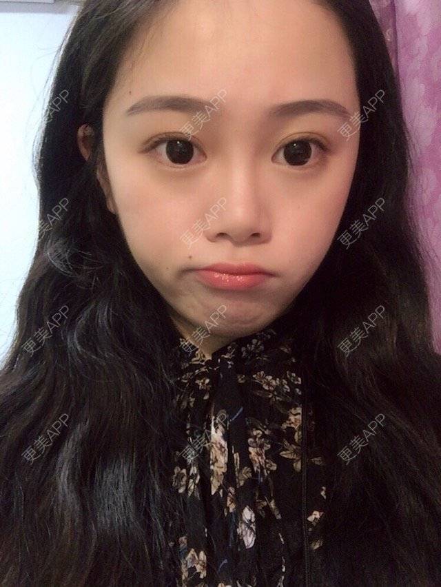 更美 - 摩西呀的水光项目经验 | 成都 | 去痘印 | 水光项目 | 光子嫩肤