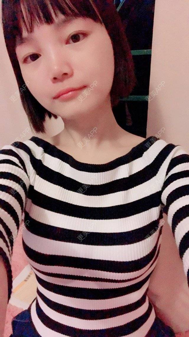 陀陀的自体脂肪隆胸日记