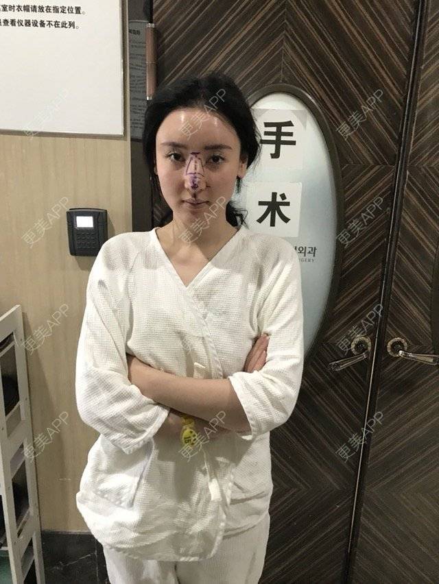 更美 - miss 苏的鼻部膨体假体取出经验 | 鼻部膨体假体取出 | 鼻骨内推 | 深圳 | 鼻部整形