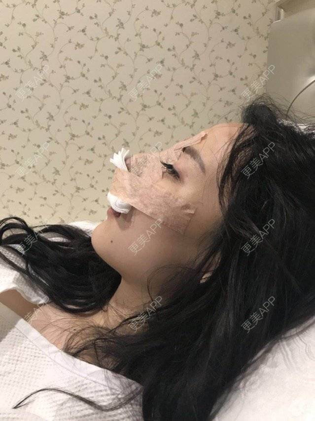更美 - miss 苏的鼻部膨体假体取出经验 | 鼻部膨体假体取出 | 鼻骨内推 | 深圳 | 鼻部整形