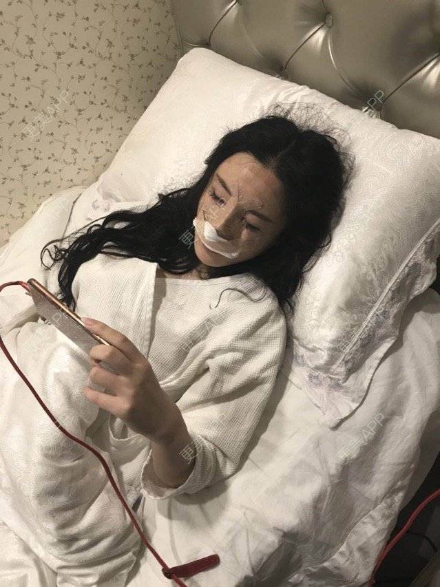 更美 - miss 苏的鼻部膨体假体取出经验 | 鼻部膨体假体取出 | 鼻骨内推 | 深圳 | 鼻部整形