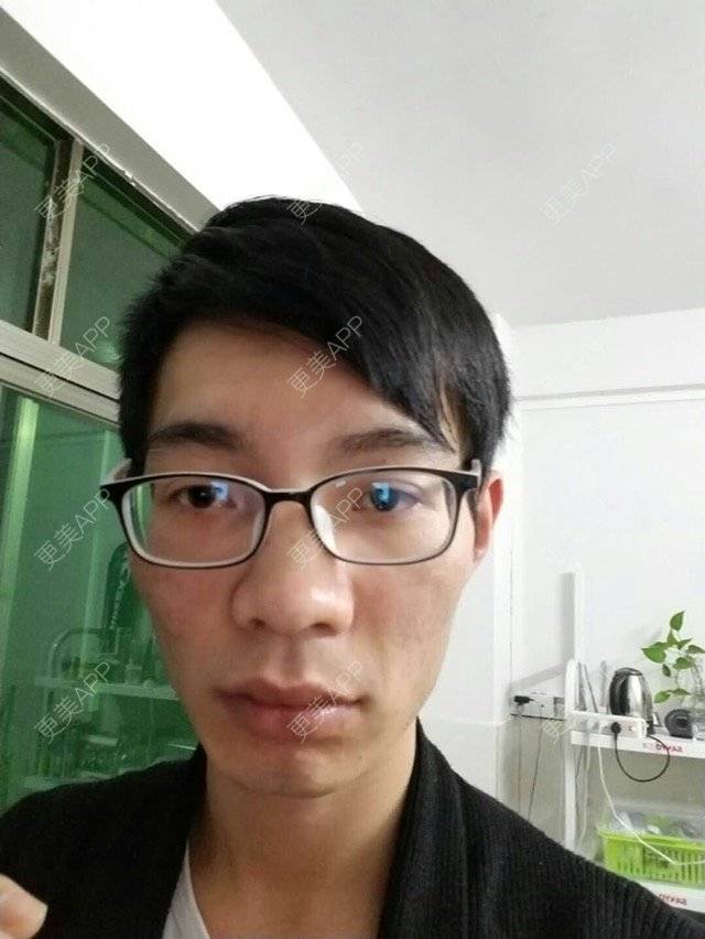 更美 - 更美用户PdQrraCkOQ的红蓝光清痘经验 | 红蓝光清痘 | 祛疤痕痘印 | 祛痘疤 | 广州