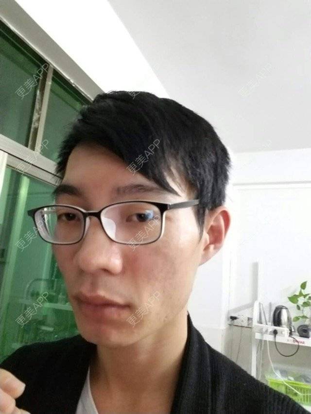 更美 - 更美用户PdQrraCkOQ的红蓝光清痘经验 | 红蓝光清痘 | 祛疤痕痘印 | 祛痘疤 | 广州