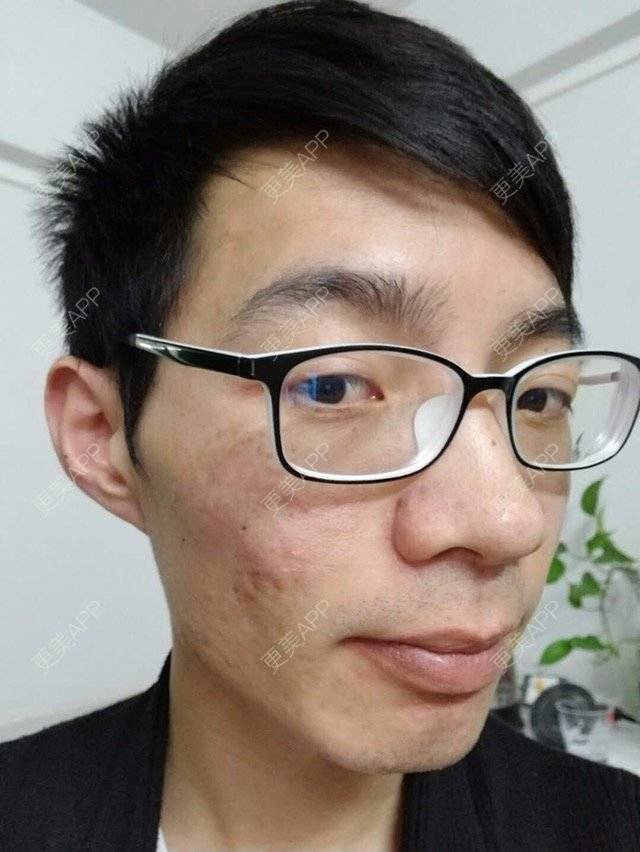 更美 - 更美用户PdQrraCkOQ的红蓝光清痘经验 | 红蓝光清痘 | 祛疤痕痘印 | 祛痘疤 | 广州