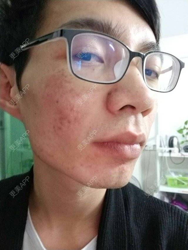更美 - 更美用户PdQrraCkOQ的红蓝光清痘经验 | 红蓝光清痘 | 祛疤痕痘印 | 祛痘疤 | 广州