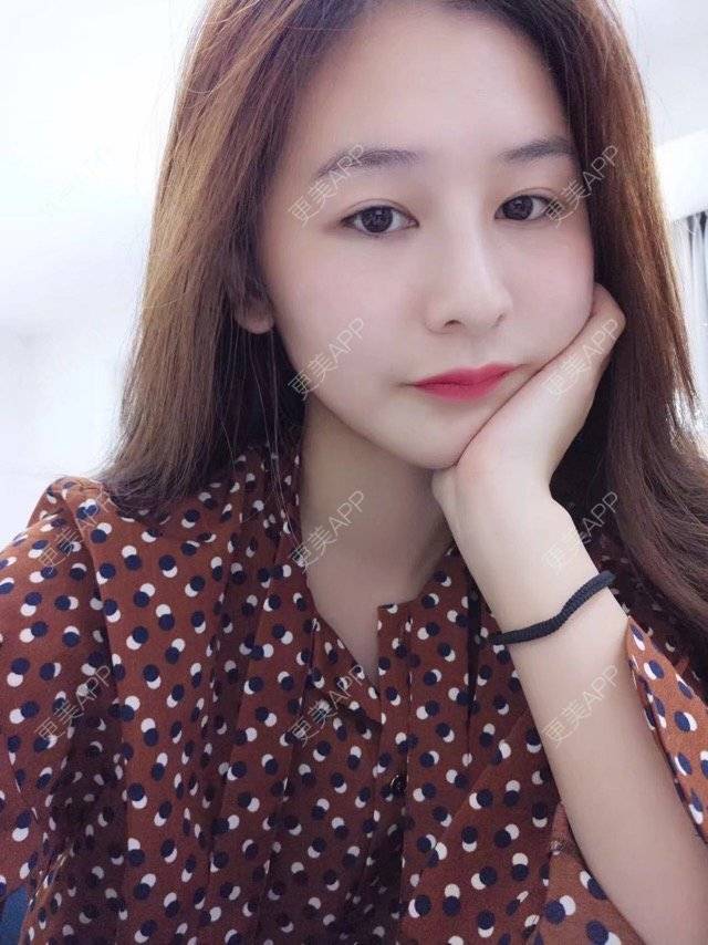 更美 - 请叫我雅雅的埋线提升经验 | 成都 | 埋线提升 | 自体脂肪填充全面部 | 自体脂肪填充面颊