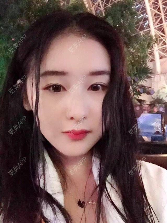 更美 - 请叫我雅雅的埋线提升经验 | 成都 | 埋线提升 | 自体脂肪填充全面部 | 自体脂肪填充面颊