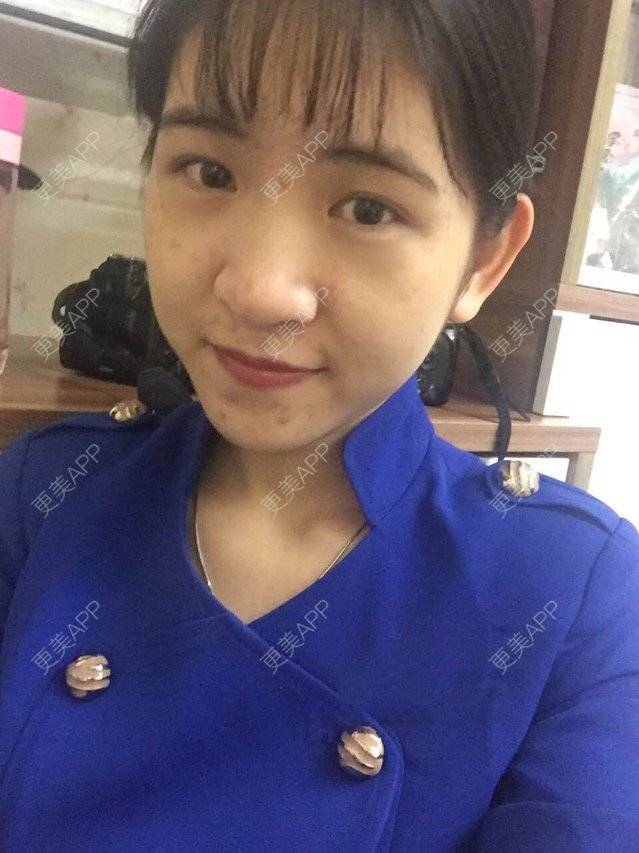 更美 - 咿呀咿呀哟。。的果酸焕肤经验 | 祛疤痕痘印 | 果酸祛痘 | 果酸焕肤 | 广州
