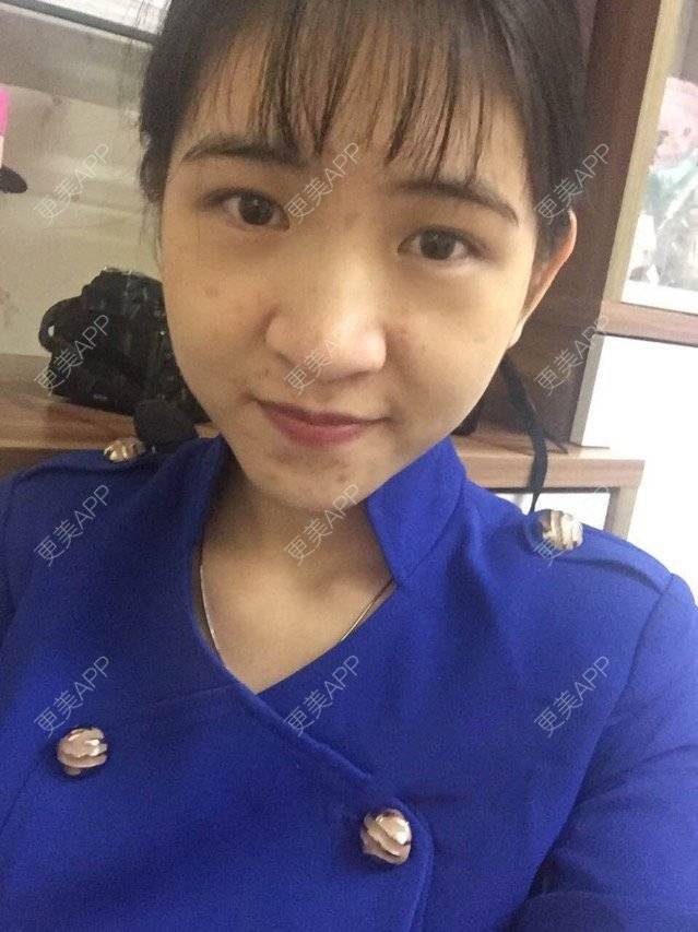 更美 - 咿呀咿呀哟。。的果酸焕肤经验 | 祛疤痕痘印 | 果酸祛痘 | 果酸焕肤 | 广州